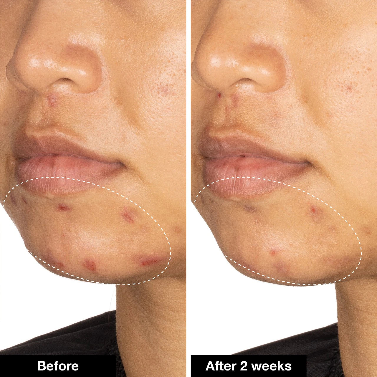Acne Serum Medicated Treatment – Kriz Reales Studio